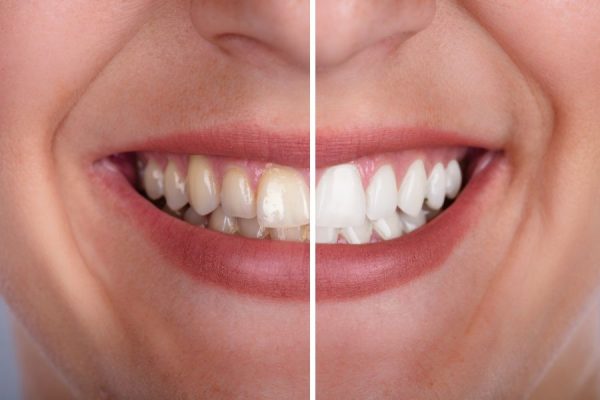 Clareamento Dental