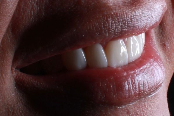 Lentes de Contato Dental 2