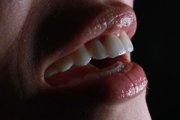 Lentes de Contato Dental